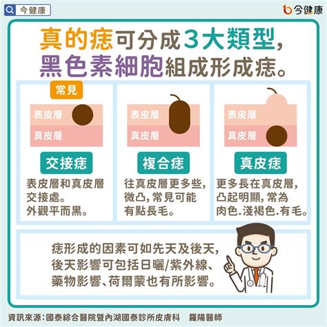 為什麼痣會長毛|是痣？皮膚癌？還是什麼？常見Q&A解惑！醫教揪出「假的痣」